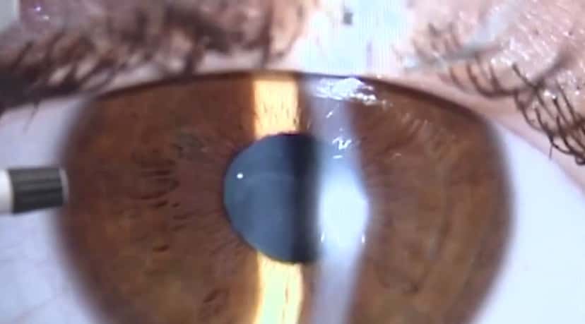 В России создали искусственную роговицу глаза