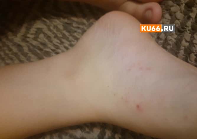 Мать ребёнка из Каменска-Уральского пожаловалась на клопов в детском лагере 