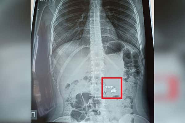 Плюс одна фобия: 15-летняя россиянка проглотила во сне наушник и оказалась в больнице