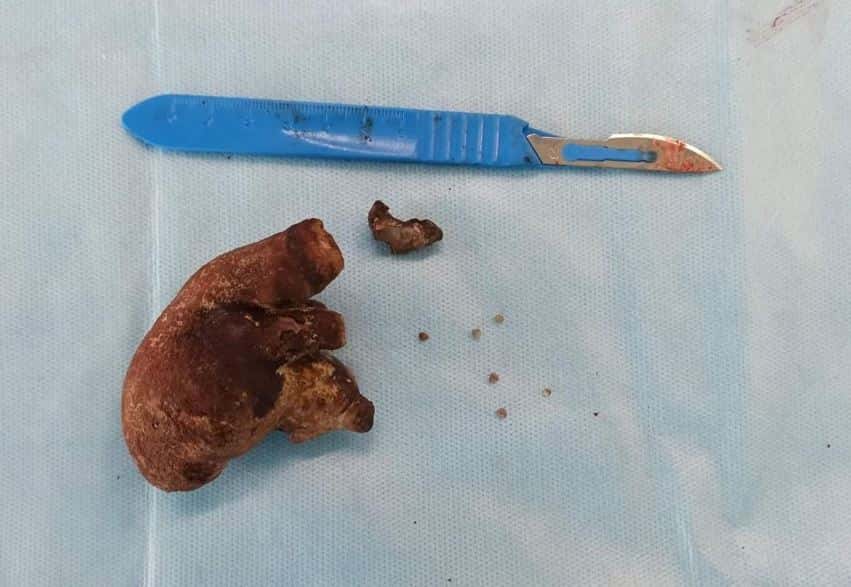 В Чебоксарах из тела женщины, игнорировавшей симптомы болезни, достали гигантский камень