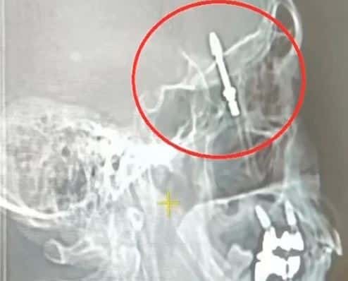 Турецкий стоматолог менял пациенту зуб и случайно просверлил мозг