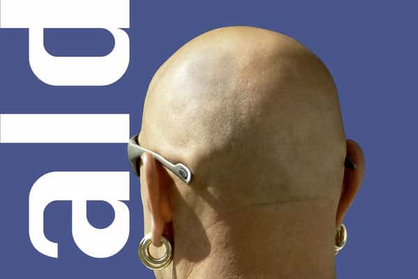 Простое лекарство от облысения: природный сахар