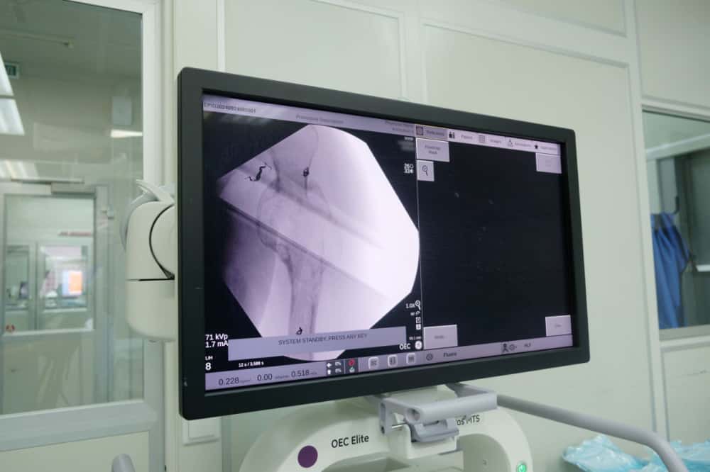 Свердловские врачи спасли пациенту руку, вставив 3D-имплант