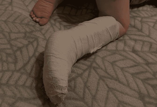 Ребенок сломал ногу в детском саду Каменска-Уральского