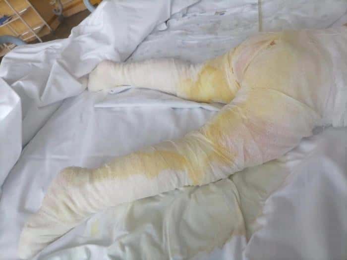 Обварила ноги в кипятке: в Ижевске двухлетняя девочка ушла домой из сада с ожогами и волдырями. Фото