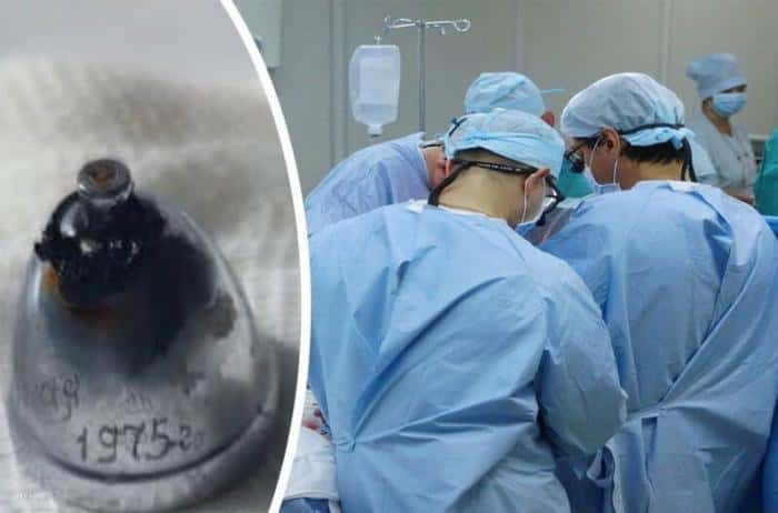 Как колокольчик оказался в легком свердловчанина: история, которая шокировала врачей