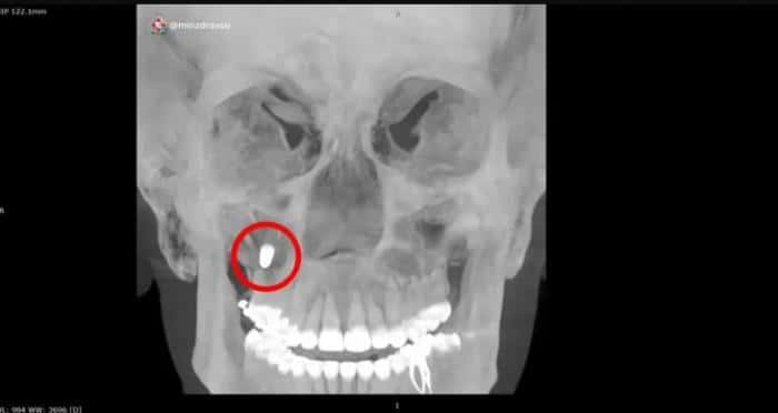 Как зубной имплант оказался в носу: уникальная операция в Екатеринбурге