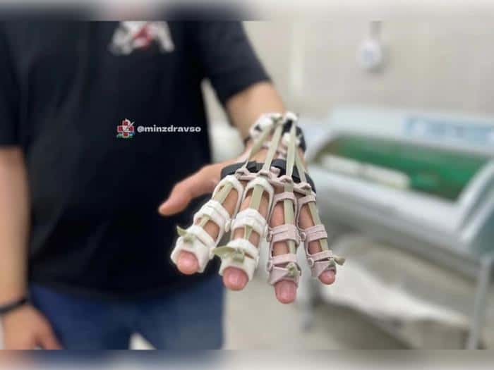 Свердловские врачи чудом спасли военного с изуродованной челюстью и рукой после ранения