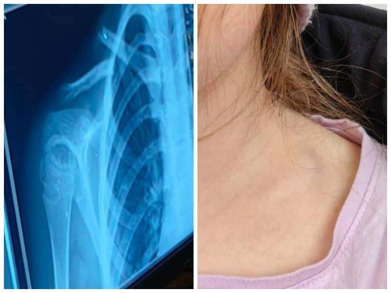 Школьница на свой день рождения сломала ключицу в игровой комнате Каменска-Уральского