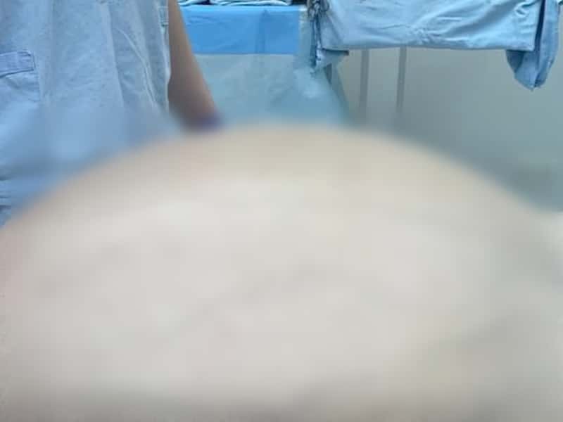 «Я с ней даже бегал»: врачи в Екатеринбурге вырезали пациенту опухоль весом 60 кг