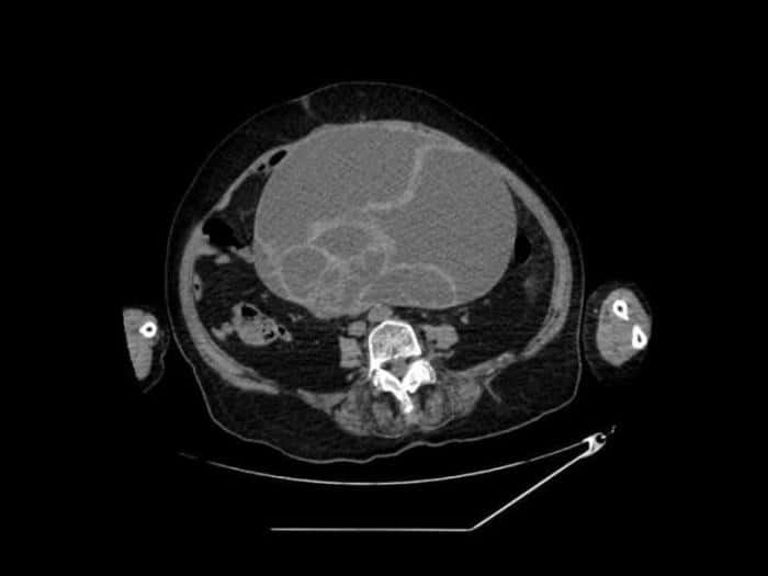 «Это было чудо»: врачи в Свердловской области достали из живота пенсионерки опухоль весом 4,5 кг