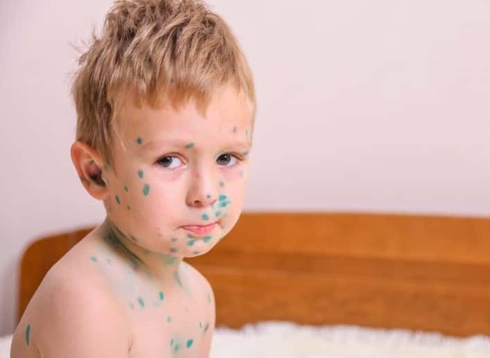Ветрянка шагает по стране: почему дети массово заражаются, а вакцин не хватает