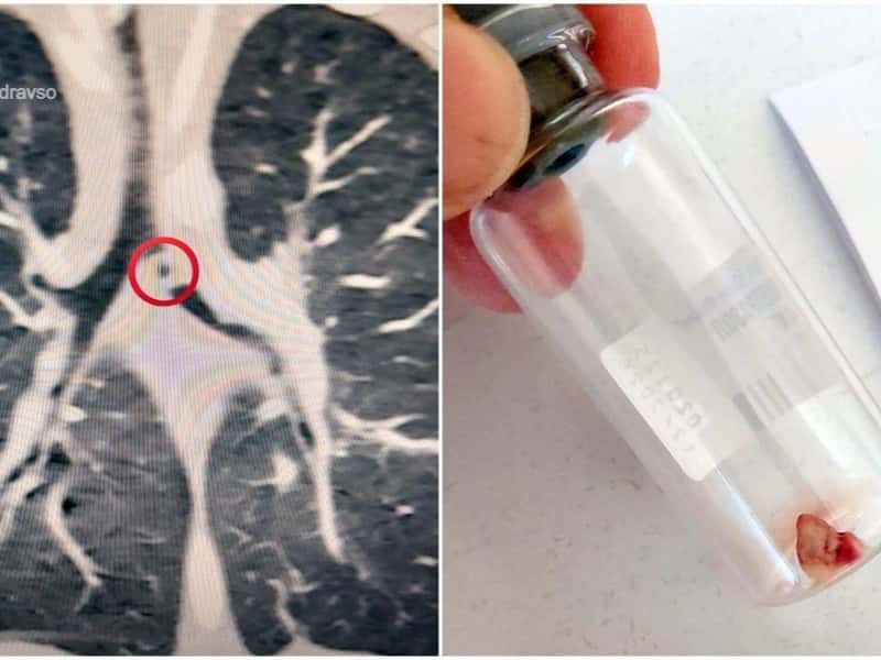 В Свердловской области годовалый ребёнок проглотил кусок деревенской печки и попал в реанимацию