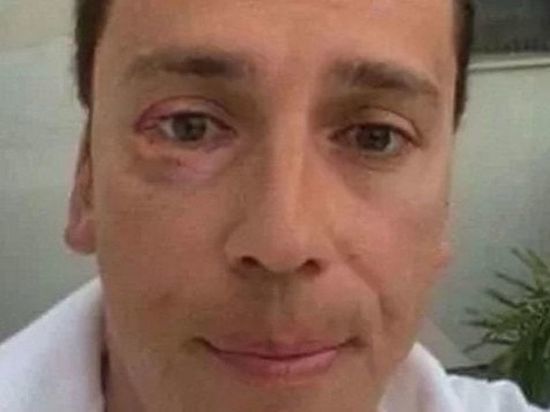 Максиму Галкину подбили глаз яблоком в Израиле за слова о России