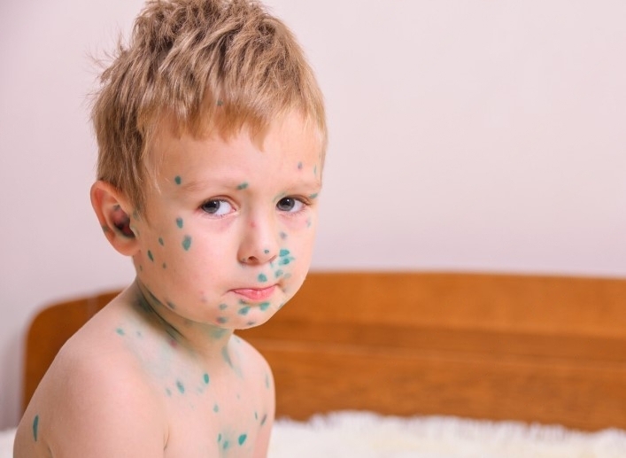 Ветрянка шагает по стране: почему дети массово заражаются, а вакцин не хватает | В России фиксируют резкий рост заболеваемости ветряной оспой 