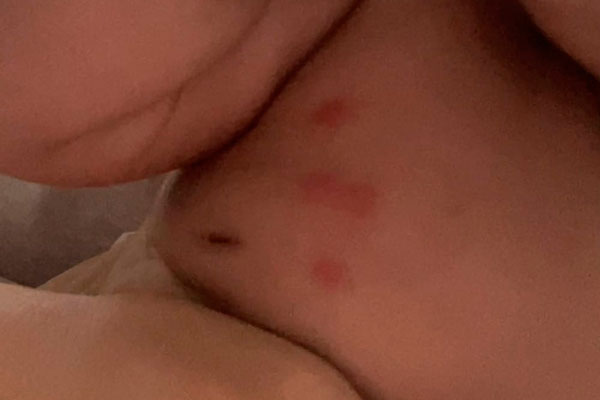 В многоэтажках Каменска-Уральского клопы кусают детей и взрослых. Собственникам никто не может помочь