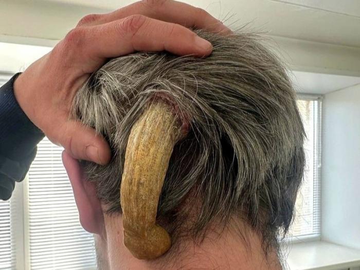 Врачи удалили у россиянина «дьявольский рог» длиной 11 см   | Жителю Набережных Челнов удалили гигантский «дьявольский рог»