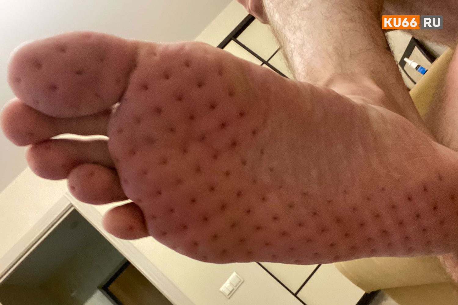 Российские ученые успешно испытали метод замены костей стопы