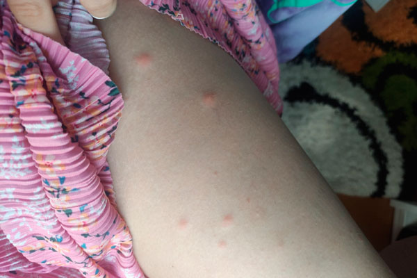 «В водоемах Свердловской области купаться запрещено!» Каменцы покрылись пятнами после купания в озере Тыгиш