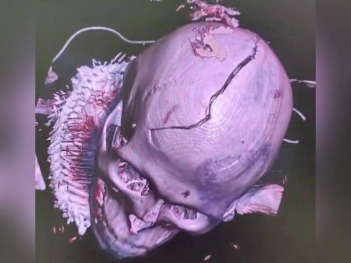 «Череп раскололся на части, кровь хлынула рекой»: как врачи спасли свердловчанина, попавшего в страшное ДТП | Врачи спасли свердловчанина, который сломал череп в ДТП