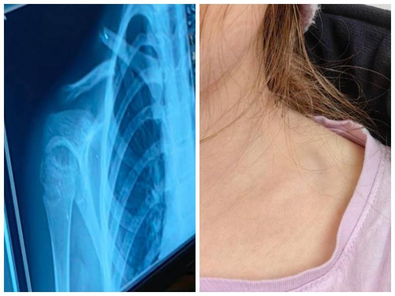 Школьница на свой день рождения сломала ключицу в игровой комнате Каменска-Уральского | В Каменске-Уральском школьница сломала ключицу в игровой комнате