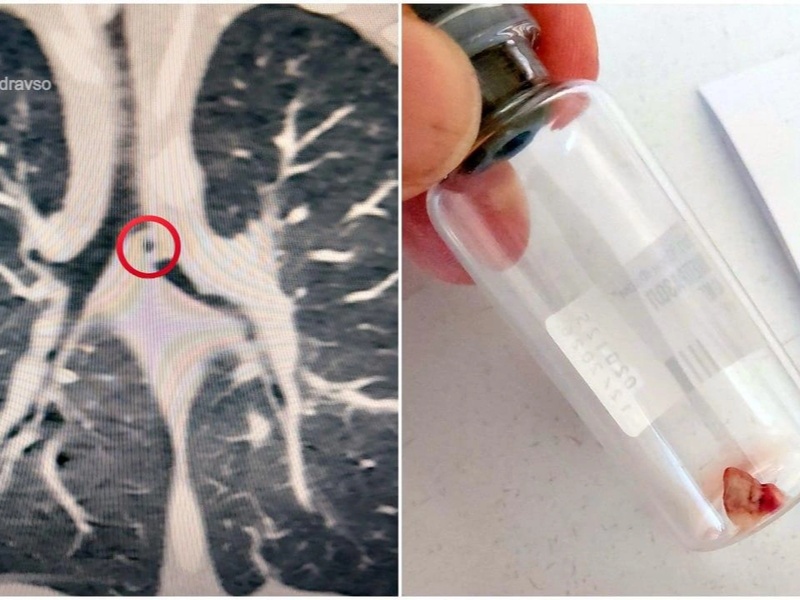 В Свердловской области годовалый ребёнок проглотил кусок деревенской печки и попал в реанимацию | Годовалый малыш проглотил кусок печки: тяжёлый случай на Урале и спасение врачей