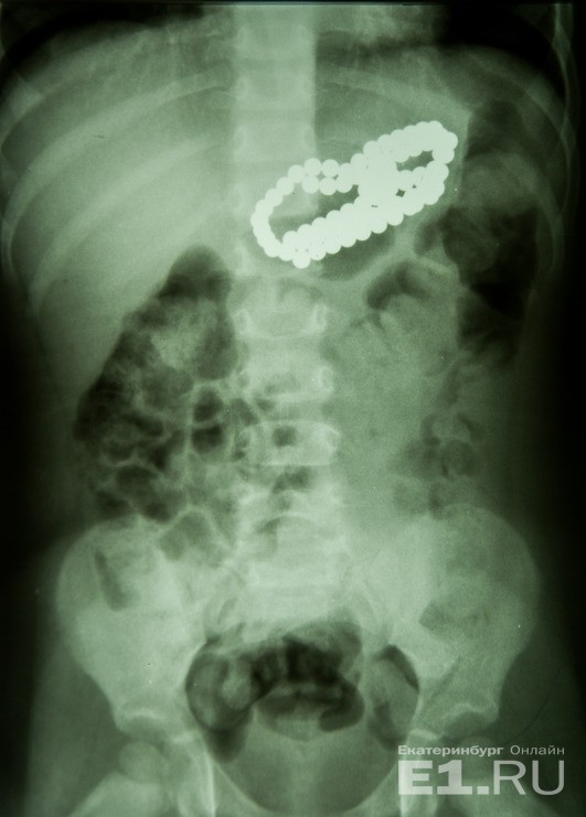 Малыш из Каменска-Уральского наглотался… магнитных шариков от детского конструктора. Оперировали в Екатеринбурге — кишку удалять не пришлось